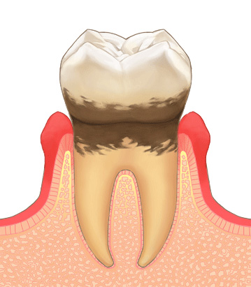 軽度歯周炎（歯肉炎）