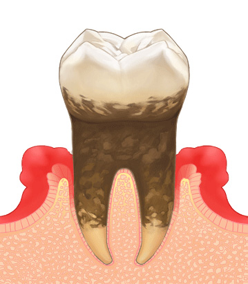 中等度歯周炎