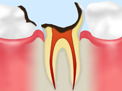 神経が死んでしまった虫歯