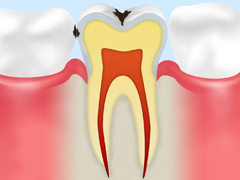 小さな虫歯